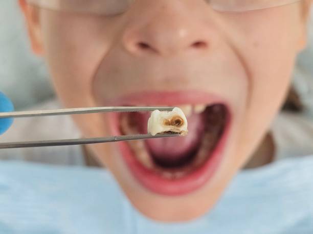 Best Dentist for Tooth Abscess  in Englewood, TN